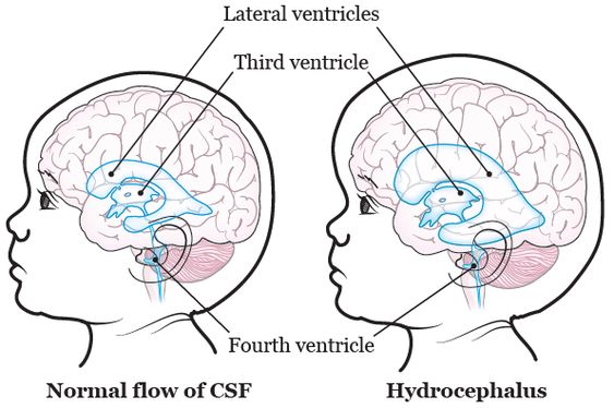 Hydrocephalus: What It Is, Causes, Symptoms, Diagnosis and Treatment